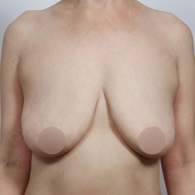 乳房縮小術を受ける前の手術前写真。