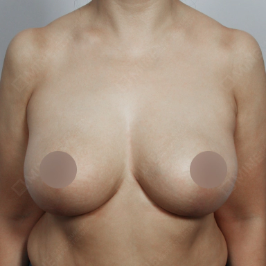乳房縮小術を受けた後の縮小されたバストの写真。