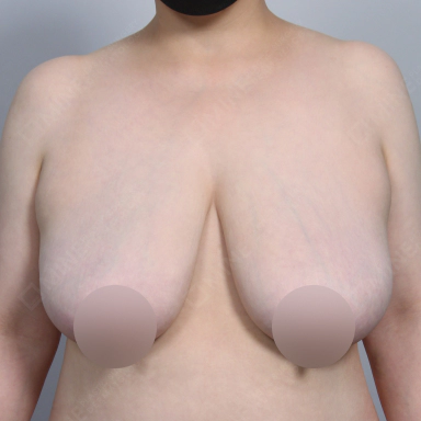 乳房縮小術を受ける前の患者のバスト写真。