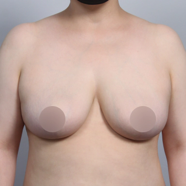 乳房縮小術を受けた後の患者のバスト写真。