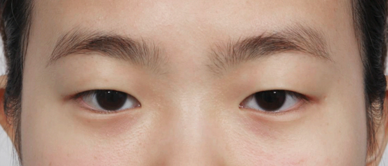 目元手術の前、上まぶたが目を覆っている状態。