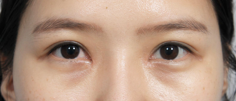 二重まぶた手術後、ラインがきれいに整った女性。
