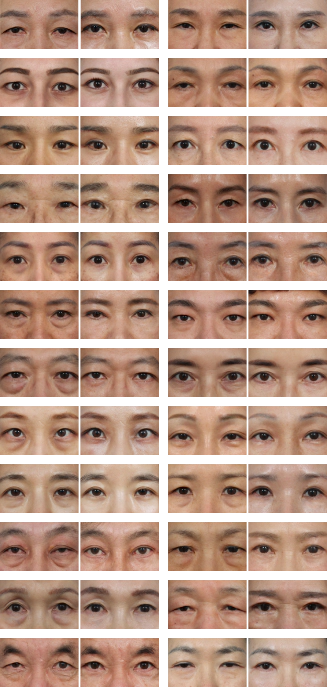 上眼瞼・下眼瞼手術後、より若々しくなった人々の施術前後の写真。