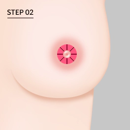 乳頭縮小・乳輪縮小手術の乳頭周囲切開法STEP02で、ゴアテックス縫合糸を用いて広い乳輪のサイズを縮小する手術手順を示すイラスト。