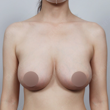 垂れ乳の豊胸手術後にふっくらとバランスの取れたバストを得た女性のアフター写真.