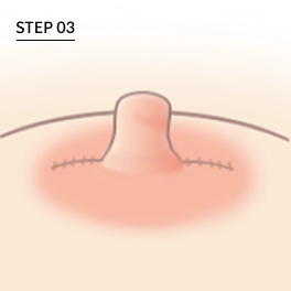 乳頭縮小・陥没乳頭整形の三角皮弁法STEP03で、乳首の形を生かしながら両側を縫合した仕上がりを示す手術手順イラスト。