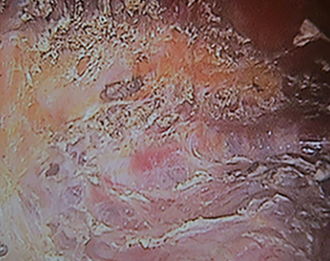 胸部内視鏡で筋肉を切除し、ドライポケットを形成する豊胸手術の説明図。