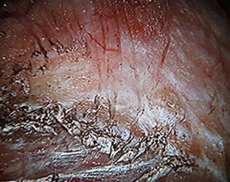 腋下内視鏡豊胸手術時に切除・保存された筋膜を示す図。