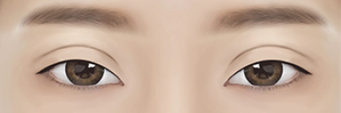 眼瞼下垂により眠そうに見える目元。