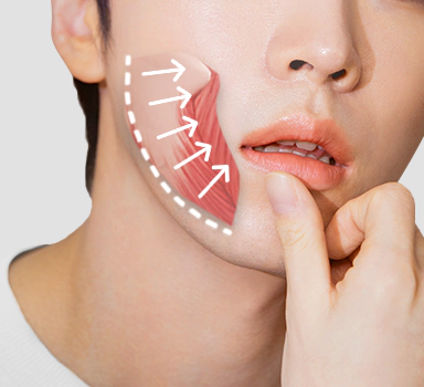 輪郭手術後のはっきりとしたフェイスラインのイメージ。