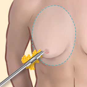 乳輪方向から切開して余分な脂肪を除去し、自然な乳房形状に整えます