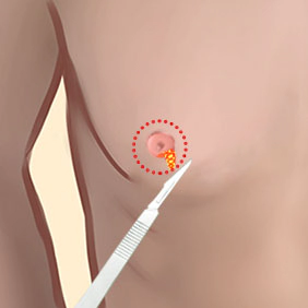 乳輪縁から切開し、乳房下部の筋膜を精密に剥離して乳腺組織を除去します。