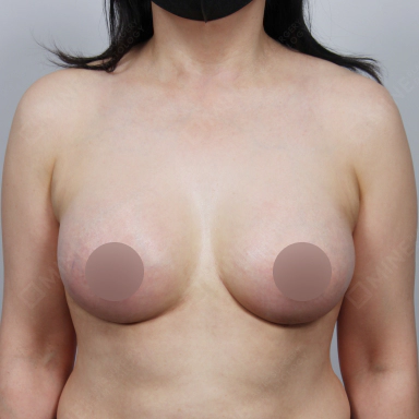 中等度の垂れ乳にインプラントを用いたバストリフト手術の症例写真。
