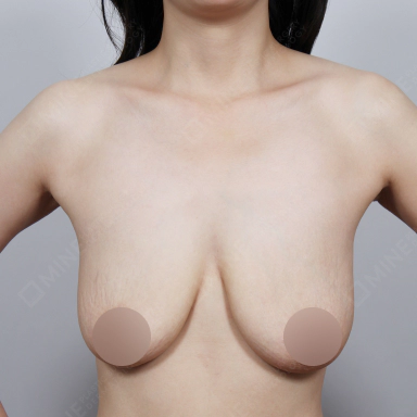 出産後に縮んで大きく垂れた垂れ乳の状態を示す写真。