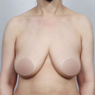 垂れ乳の程度から切開が必要なバストリフト手術の症例写真。