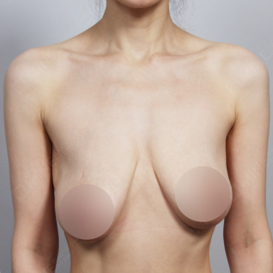 左右非対称に垂れた垂れ乳の状態を示す写真。