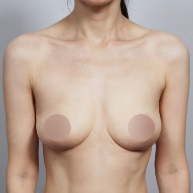 垂れ乳の豊胸手術を受けた患者の口コミ写真。