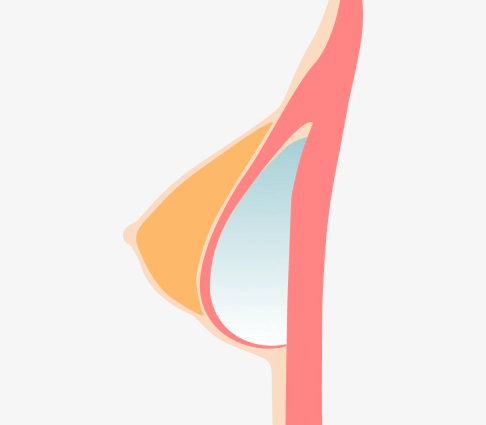 皮膚切開なしでインプラントを用いた垂れ乳のバストリフト手術のイラスト。
