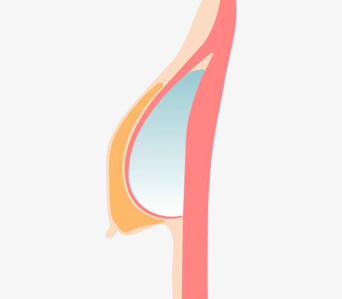 垂れ乳のデュアルプレーン手術前の状態を示すイラスト。