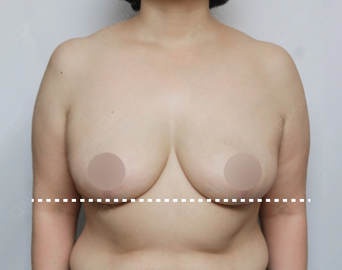 垂れ乳でバストの底線より下にバスト組織がわずかに下がっている状態を示す写真。