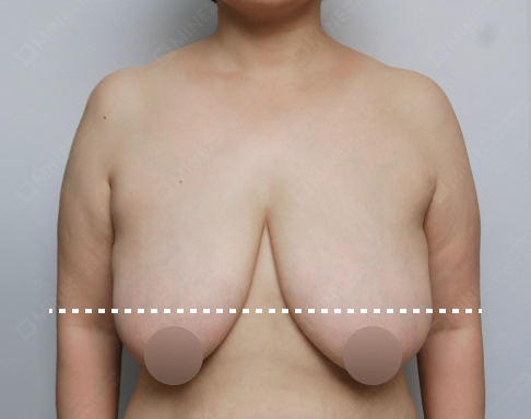 垂れ乳で乳頭がバストの底線より下に下がっている状態を示す写真。