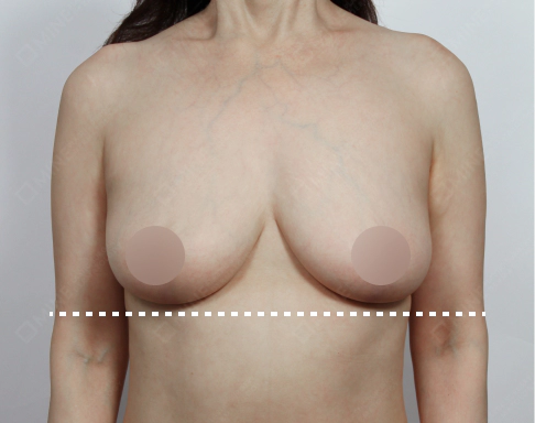 重度の垂れ乳が手術で改善されたアフター写真。