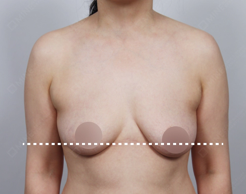 垂れ乳で乳頭がバストの底線の位置まで下がっている状態を示す写真。