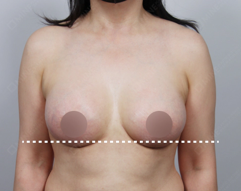 垂れ乳のバスト底線の位置を示す写真。