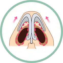 鼻翼軟骨を調整し、鼻孔の形を整える方向。