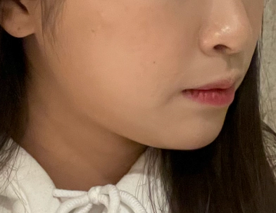 あごラインが丸く、ボトックス施術を希望する女性。