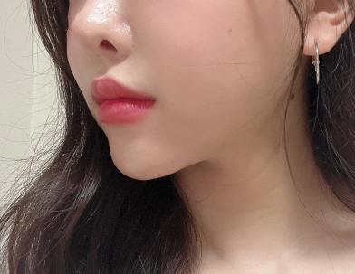 へこんだ部位へのフィラー施術でやわらかなラインを手に入れた女性。