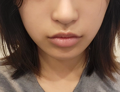 顔のラインがへこんで見えるフィラー施術前の女性。