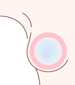 豊胸手術時、ポケットがインプラントより大きいと、内部で動きすぎてしまいます。