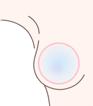 豊胸手術時にバストポケットがインプラントより小さく、インプラントが十分に広がらない状態を示す写真。