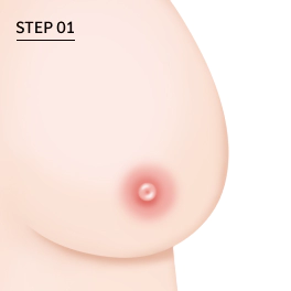 乳房縮小術前の胸の状態。