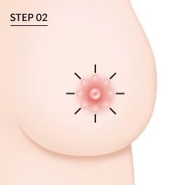 乳房縮小術で胸を小さくする際の乳輪切開法による乳輪縮小範囲。