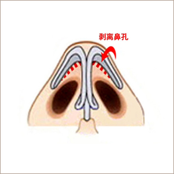 鼻部整形剥离鼻部的示意图。