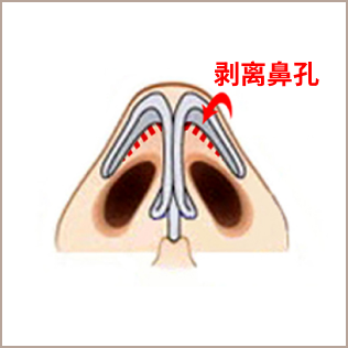 鼻部整形剥离鼻部的示意图。
