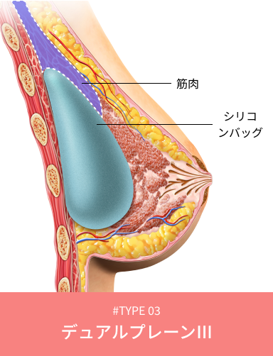 垂れ乳矯正のデュアルプレーンタイプ3を説明する図解。