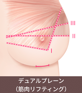 垂れ乳の切開法のうちデュアルプレーン筋肉リフトを説明するイラスト。