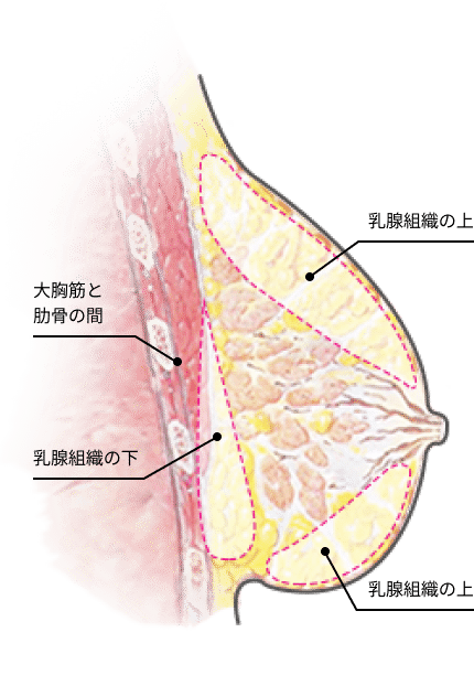 胸 脂肪注入の位置を示す断面図で、乳腺組織の上・乳腺組織の下・大胸筋と肋骨の間の3つの注入層を表示。