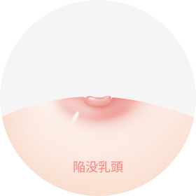 乳頭縮小・陥没乳頭整形の対象となる、乳頭が乳房内に陥没した状態を示すイラスト。