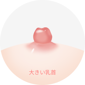 乳頭縮小手術の対象となる、サイズが大きく突出した乳頭の状態を示すイラスト。