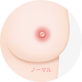 乳頭縮小・乳輪縮小手術の比較対象となる、乳頭と調和した適切なサイズの正常な乳輪の状態を示すイラスト。