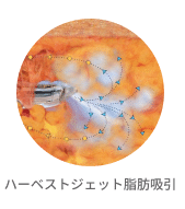 胸 脂肪注入に使用するハーベストジェット脂肪吸引の施術イメージ。