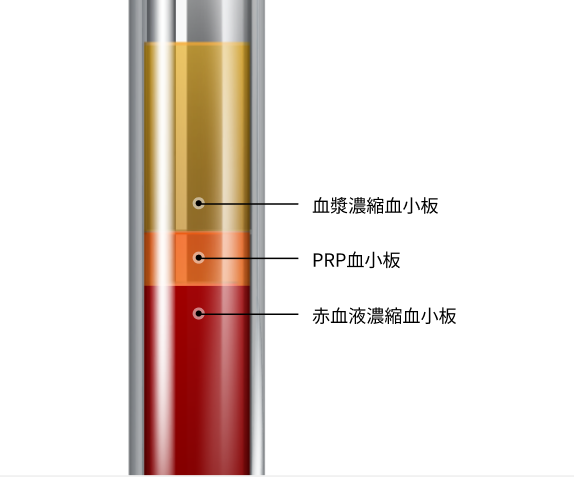 胸 脂肪注入の生着率を高めるPRP血小板の分離過程を示した試験管の断面図で、血漿濃縮血小板・PRP血小板・赤血液濃縮血小板の3層を表示。