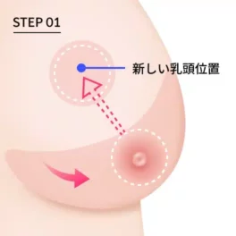 乳房縮小術における胸下切開法の第1段階を説明する写真。