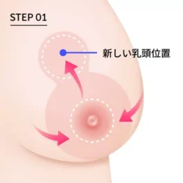 乳房縮小術における垂直切開法の第1段階を説明する写真。