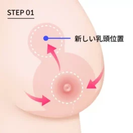 乳房縮小術の逆T字切開法の第1段階（新しい乳頭の位置）を示す図。