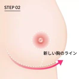 乳房縮小術の逆T字切開法の第2段階（新しい胸のライン）を示す図。